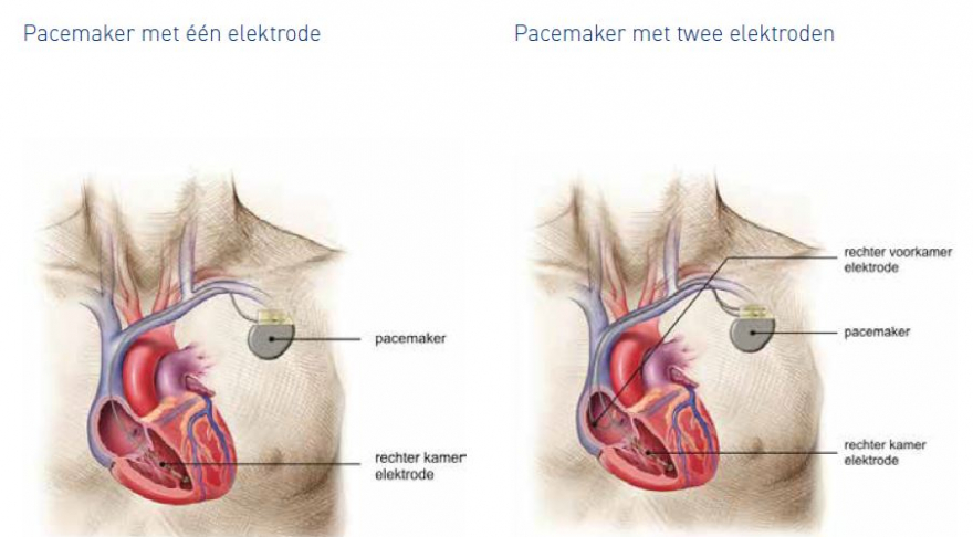 Pacemaker soorten